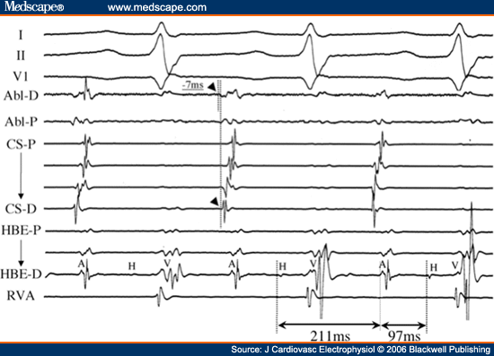 Intracardiac Electrocardiogram