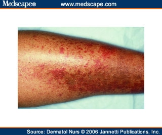Non-blanching erythematous papules are the notable findings of these ...