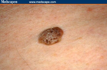 benign skin tumor