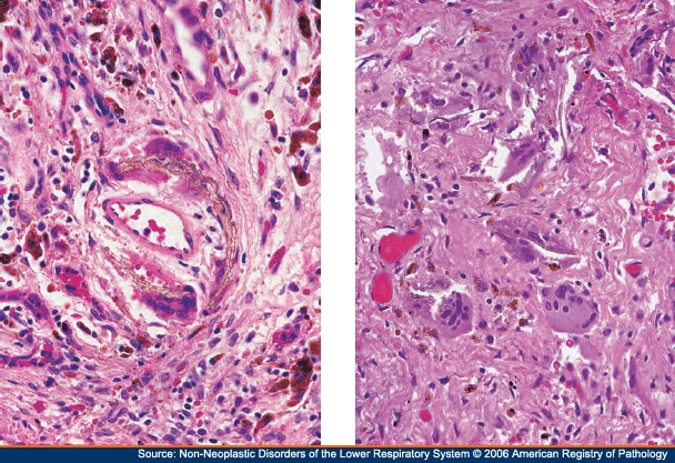 Dense Irregular Connective Tissue. Right: The fragmented elastic