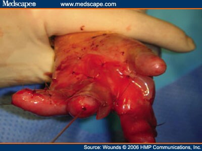 Denuded wound Nude Photos 66 Denuded wound Nude Photos 60