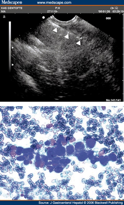 Endoscopic Ultrasound-Guided Fine Needle Aspiration Biopsy: Biopsy ... Endoscopic Ultrasound-Guided Fine Needle Aspiration Biopsy: Biopsy ...