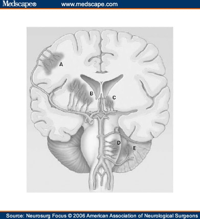 Posterior Cerebral Artery. posterior cerebral artery;