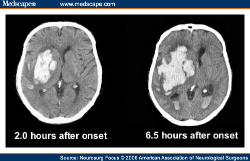 Intracranial Hemorrhage, Hypertensive; Cerebral Hemorrhage ...