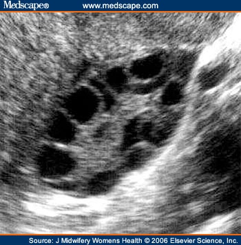 of a polycystic ovary.