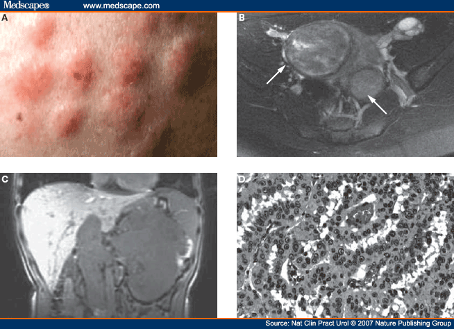 Mechanisms of Disease: Hereditary Leiomyomatosis Renal Cell Cancer ...