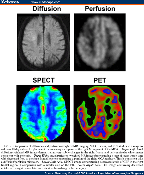 Cerebral Perfusion Scan