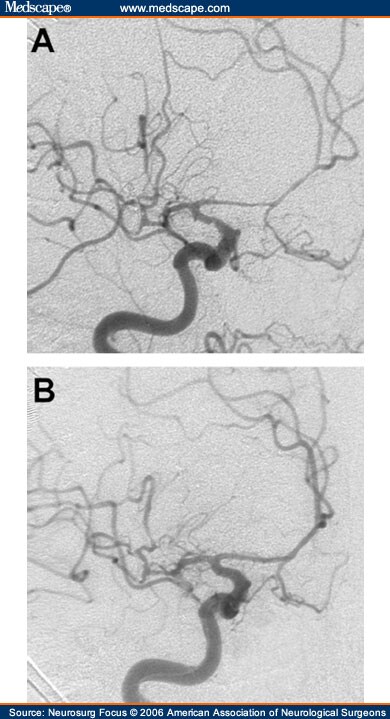 Mca Angiogram