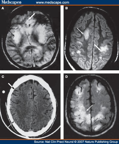 mri brain scan. T2-weighted MRI brain scan