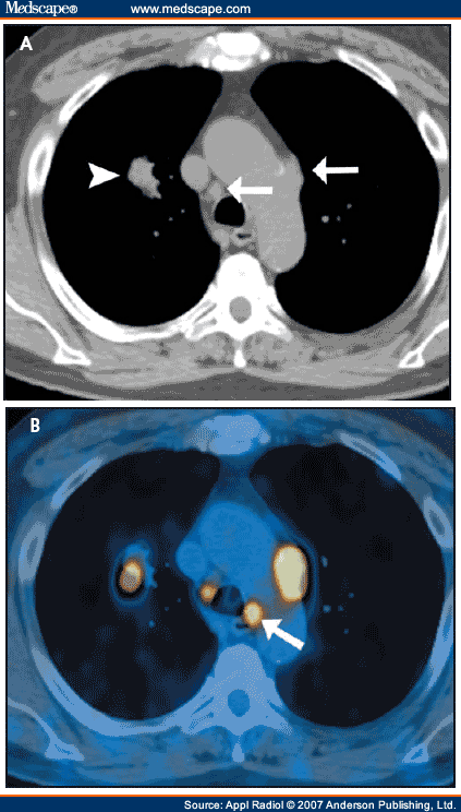 Imaging of the mediastinum in oncology