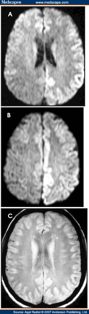 cjd eeg findings