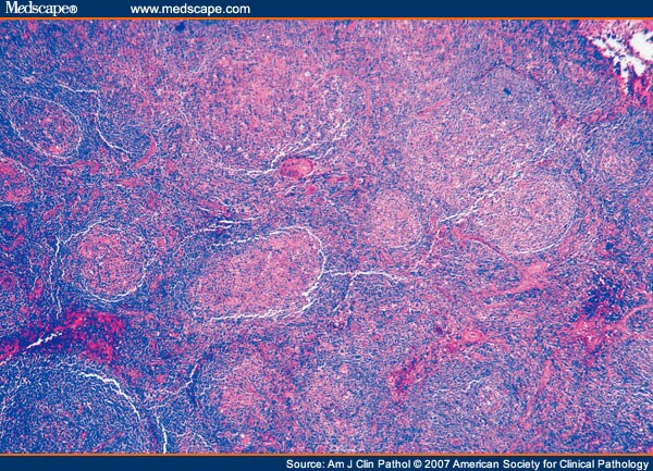 Follicular lymphoma in adults