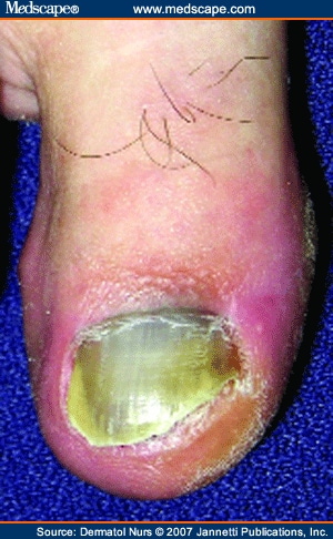  (B) of the right great toe demonstrate the nail plate discoloration that 