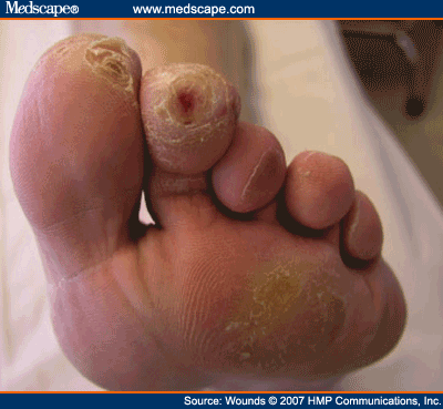 Diabetic Toe Ulcer