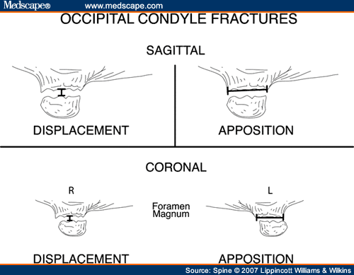 occipital condyle fracture