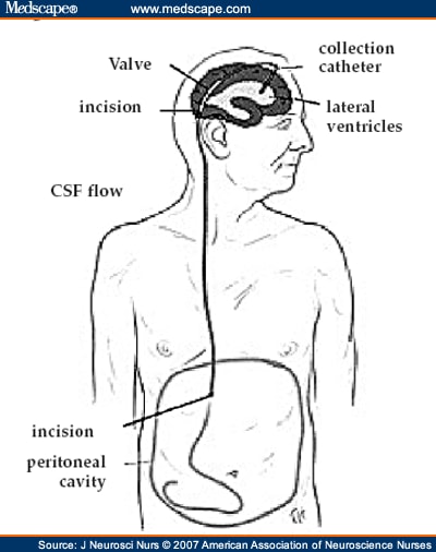 ventriculoperitoneal shunt