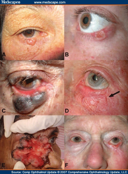 Nodular Basal Cell Carcinoma. A: Nodular basal cell