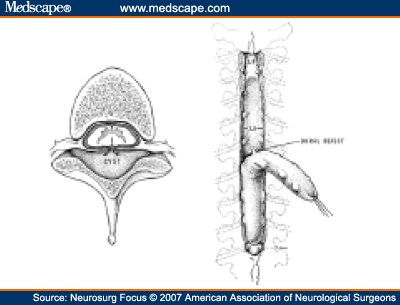 Spinal Arachnoid Cyst