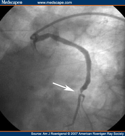 stent stents complications dissolving