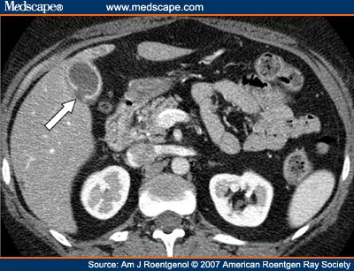 abnormal gallbladder ultrasound images. Emphysematous+gallbladder+