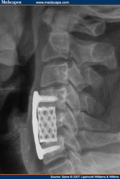 Cervical Corpectomy