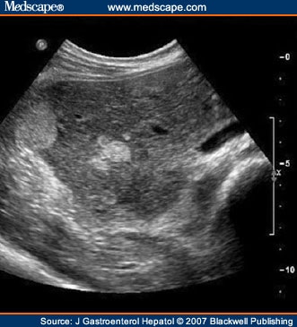Hepatic Adenoma Ultrasound