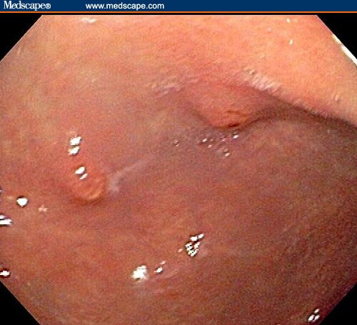 Polyps in the antrum of the stomach.