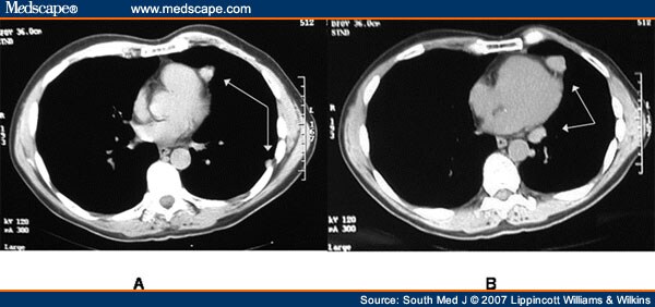 Splenosis Ct