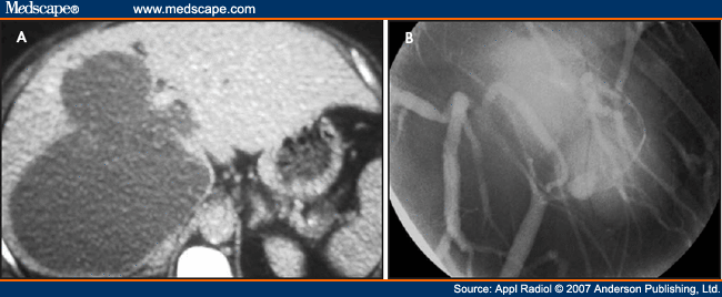 Imaging of Cystic Liver Lesions in the Adult