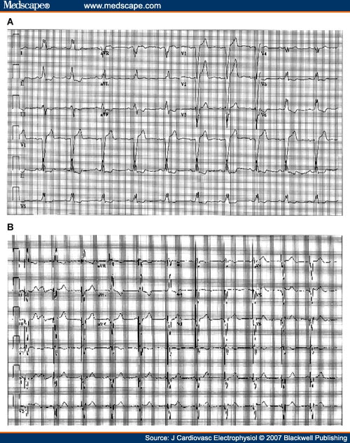 ecg heart rate