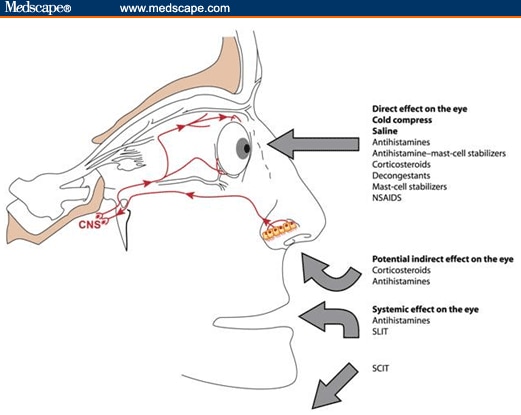 Routes of ocular allergy therapy administration.