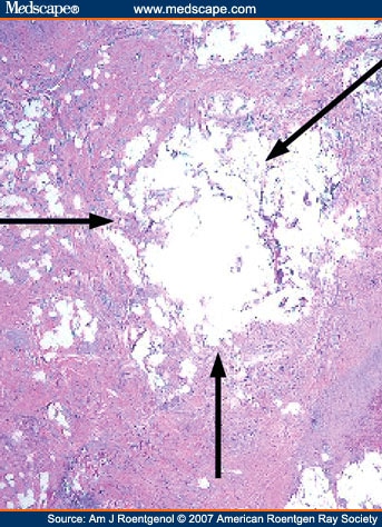 initial experience with digital breast tomosynthesis in screening mammography To book 3d mammography and tomosynthesis breast cancer screening using tomosynthesis in al “initial experience with digital breast. initial experience with digital breast tomosynthesis in screening mammography To book 3d mammography and tomosynthesis breast cancer screening using tomosynthesis in al “initial experience with digital breast.