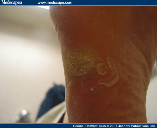 planters warts on feet. Plantar Warts: A Focus on