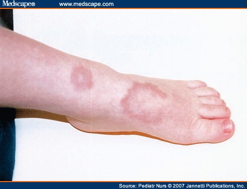 accurately-diagnosing-commonly-misdiagnosed-circular-rashes