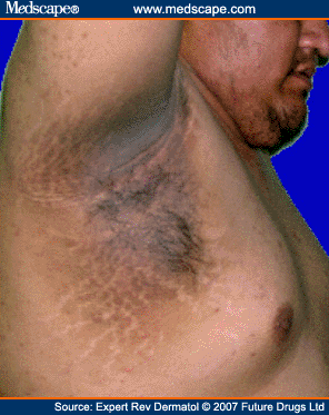 Acanthosis Nigricans Children