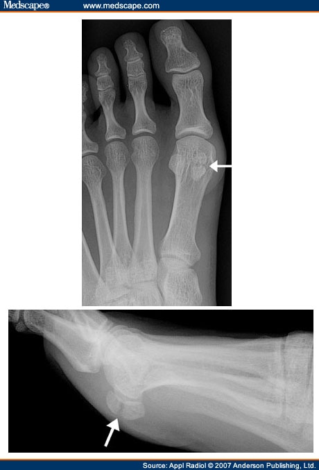 sesamoid bone fracture