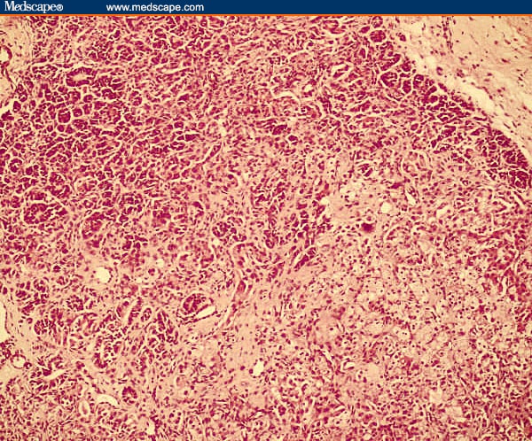 Leydig cell tumor photo