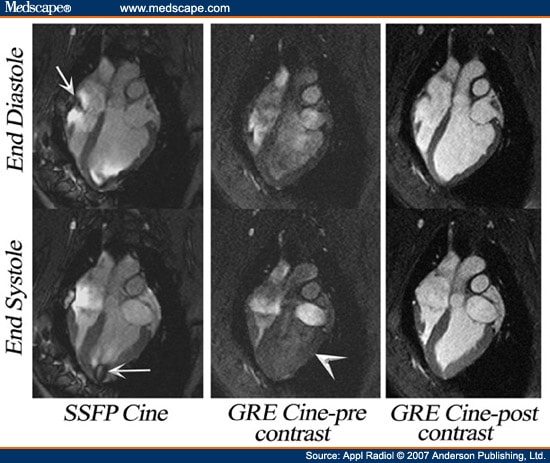 cine mri