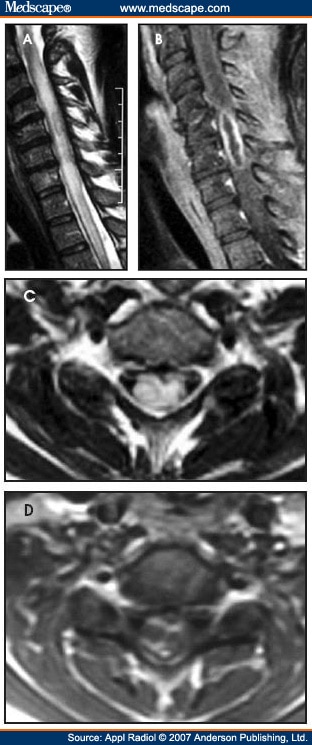 Intramedullary Spinal Cord Abscess Among Children Encyclopedia Mdpi