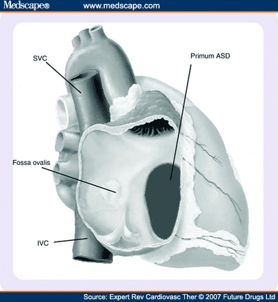 ostium primum defect