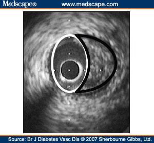atheromatous unfolding