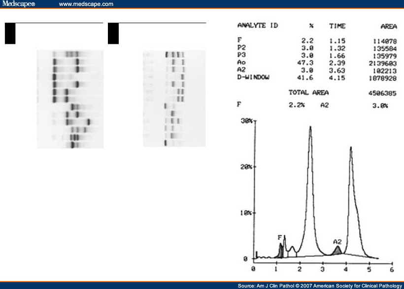 Hemoglobin Ypsilanti A HighOxygenAffinity Hemoglobin