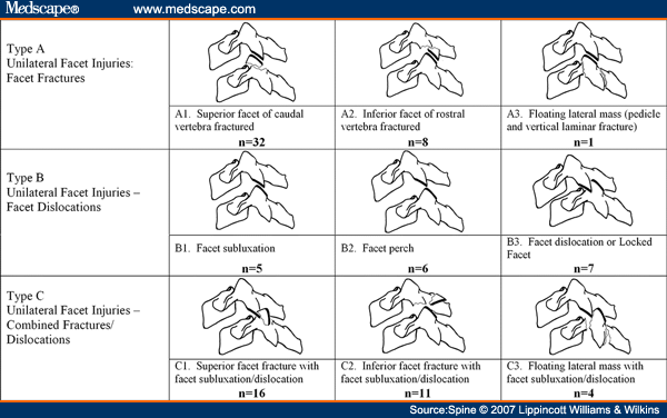 cervical facet fracture