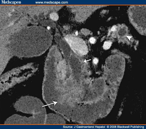 common bile duct. of the common bile duct