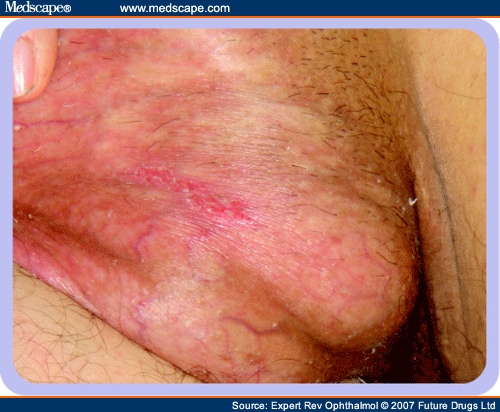 ulcers on tongue. Healing genital ulcer and scar