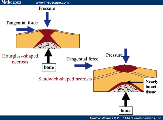 mechanism of necrosis