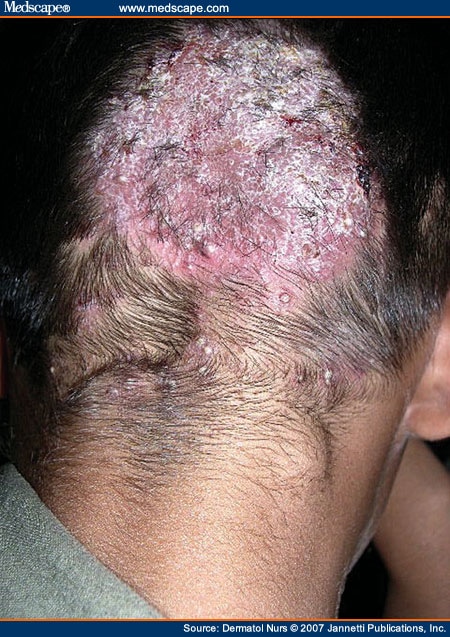 http://img.medscape.com/fullsize/migrated/569/799/dn569799.fig1.jpg