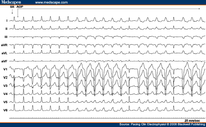 Atrial Overdrive Pacing Inducing QRS Complexes of Varying ... ladder diagram ekg 