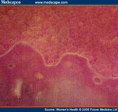 wiki vaginale intraepitheliale neoplasie wiki vaginale intraepitheliale neoplasie