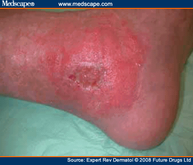 Allergic contact dermatitis from topical medication in a leg-ulcer patient.